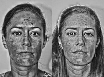 Cosmion Mask and M2 Treatment of Melasma after 353872
