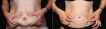 Smart Lipo before 362297