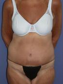 Body Lift after 329945