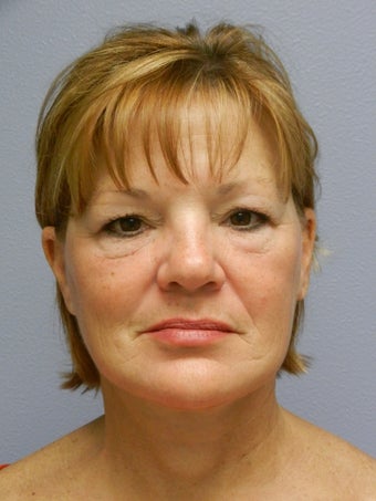 Lower Face with Neck Lift after 574623