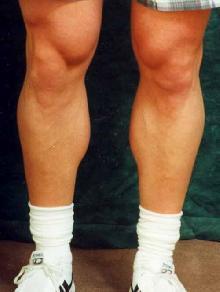 Men's Calf Augmentation 519054