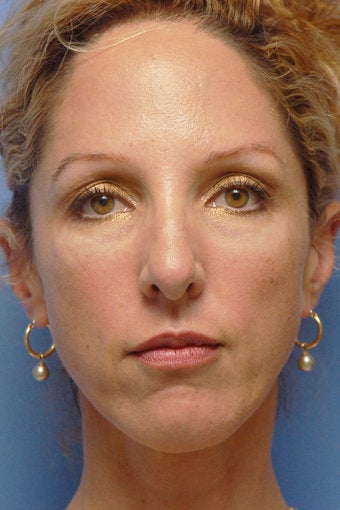 Cheek Dermafillers, Eye Dermafillers, Facial Dermafillers after 441943