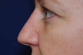 Non-Surgical Rhinoplasty after 513494