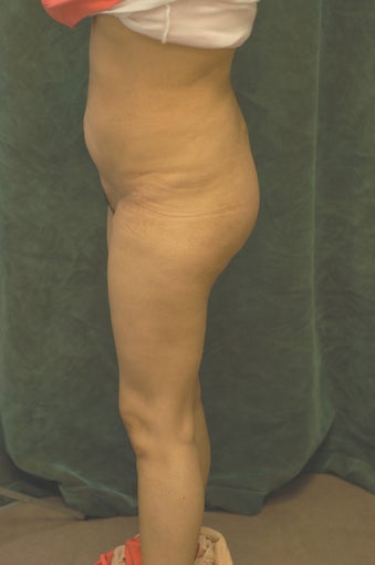 Women's Buttocks Augmentation after 518115