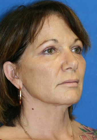 mole removal after 253859