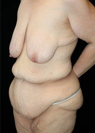 Body Lift before 363599