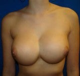 Revision Breast Surgery before 356579