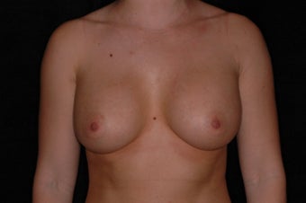 Breast Augmentation after 336380