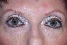 Prevelle Silk Under the Eyes after 144290