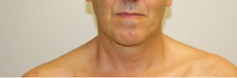 Chin Liposuction 490761
