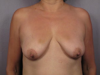 Breast Lift / Breast Augmentation before 291144