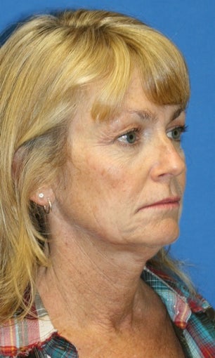 Short Incision face lift and neck lift before 223347