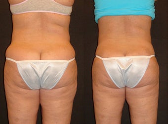 Smart Lipo before 92843