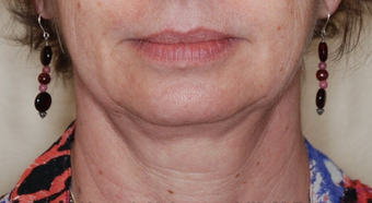 Ultherapy before 460347