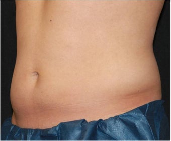CoolSculpting 421630