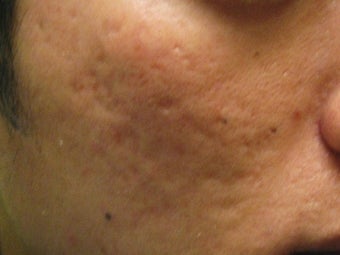 Artefill treatment of Acne Scars before 272001
