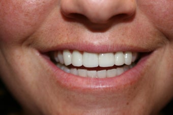 Veneers after 465803