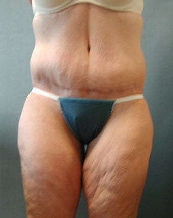 Lower Body Lift after 410337