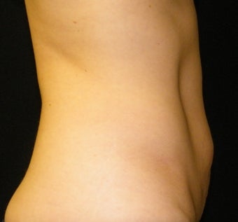 CoolSculpting after 621992