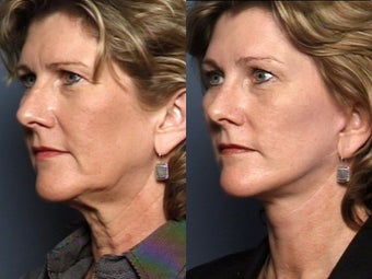 Brow Lift before 338616