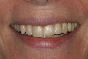Porcelain Veneers before 213079