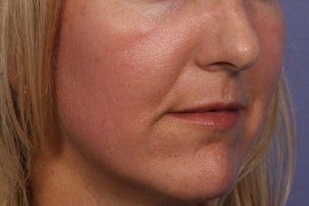 Fraxel Dual Laser after 309242
