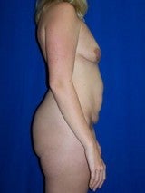 Breast Lift with Implants, Mommy Makeover, Tummy Tuck (Abdominoplasty) 412072