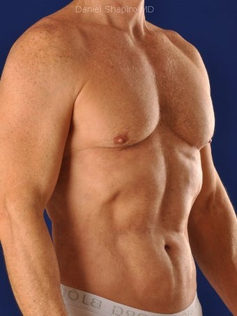 Vaser Hi Def Liposuction of chest, abdomen, back and flanks 422687
