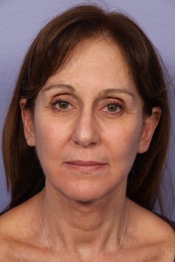 53 yr old Face and Necklift after 622092