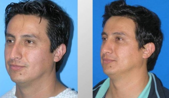 Rhinoplasty before 293537