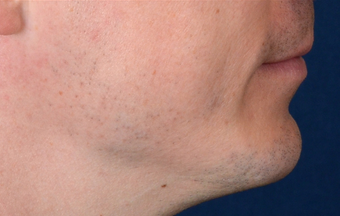 Chin Implant after 555167