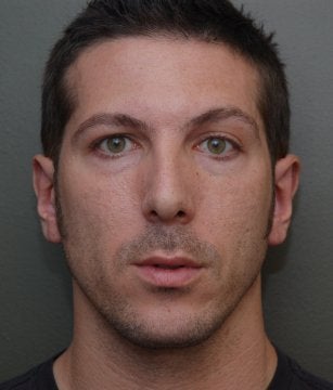 Otoplasty after 270414