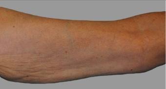 Exilis before 424062
