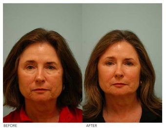 Fat Transfer/Fat Grafting/Facial Rejuvenation before 136352