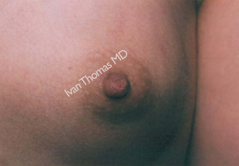 Nipple Surgery after 243260