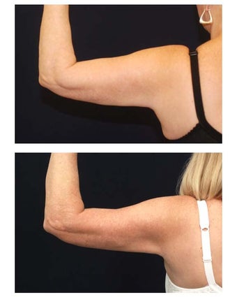 Liposuction before 286789
