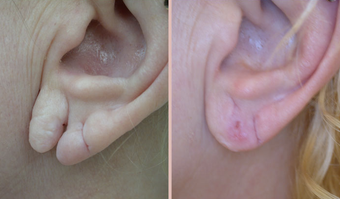 Earlobe Repair before 293448