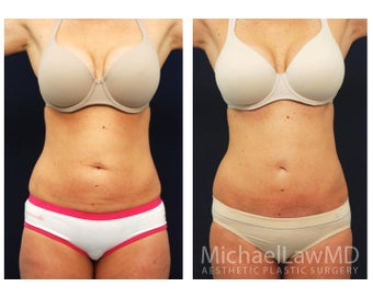 Abdominoplasty - Tummy Tuck before 396097