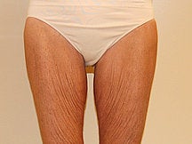 Thigh Lift before 601424