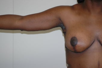 Arm Lift (brachioplasty) 333738