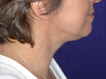 Necklift 208443