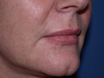 Before and After Lip Juvederm after 57749
