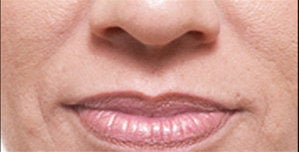 Restylane® before 388346