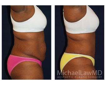 Abdominoplasty - Tummy Tuck 396144
