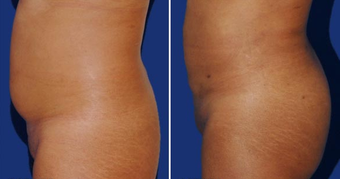 Brazilian Butt Lift before 494512