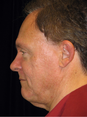Facelift, Chin Implant, Browlift before 240047