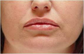 Lip augmentation after 251711