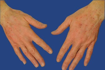 Dermal Filler for Hand Rejuvenation after 513513