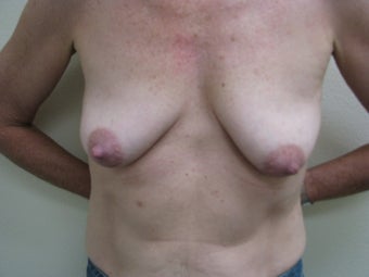 Breast Reconstruction Immediate before 347580