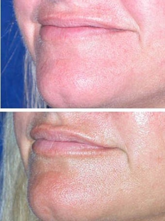 Radiesse to naso-labial folds before 6518